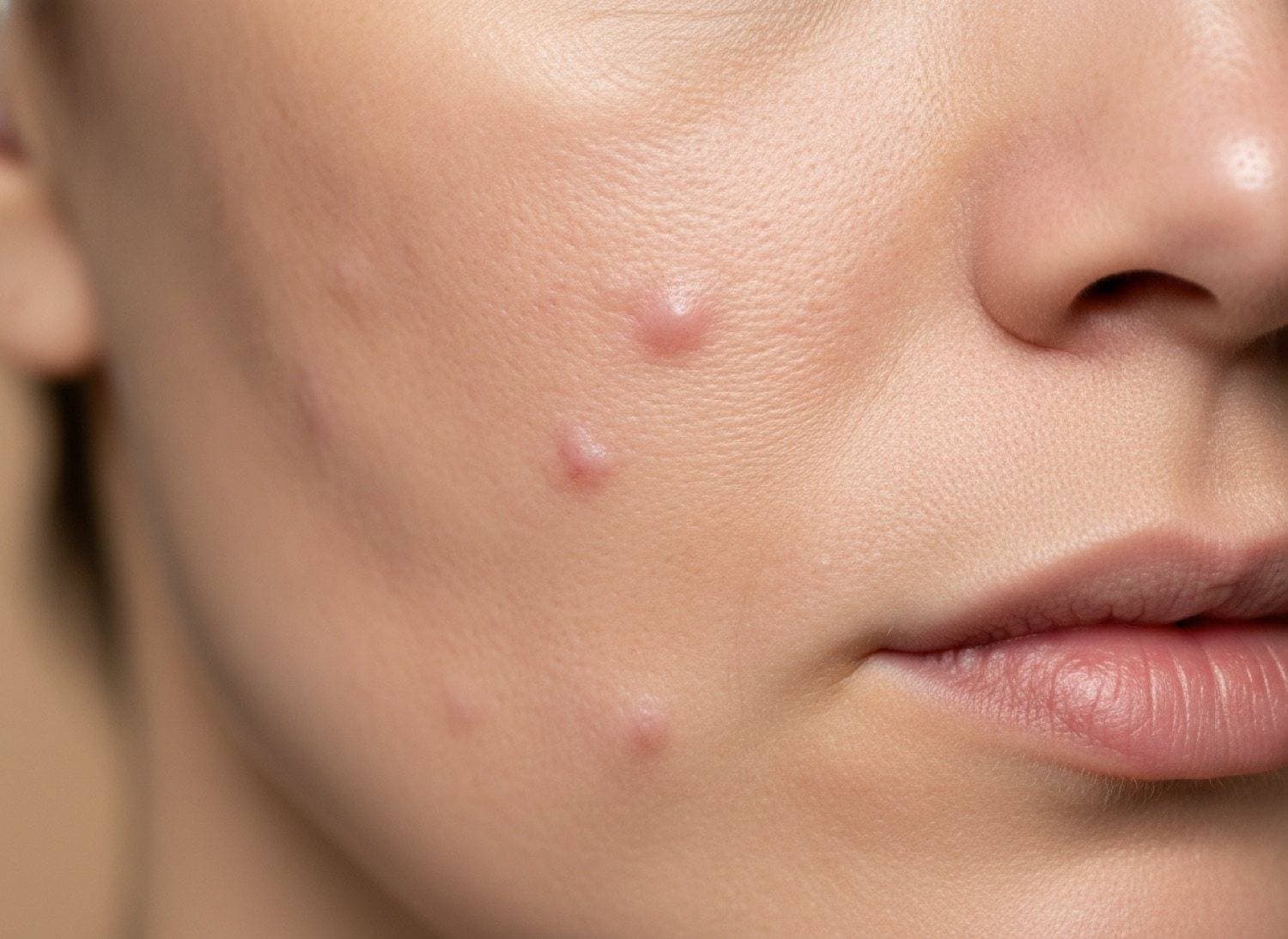 Before Refined texture and softened acne scars at The Body Bar MD