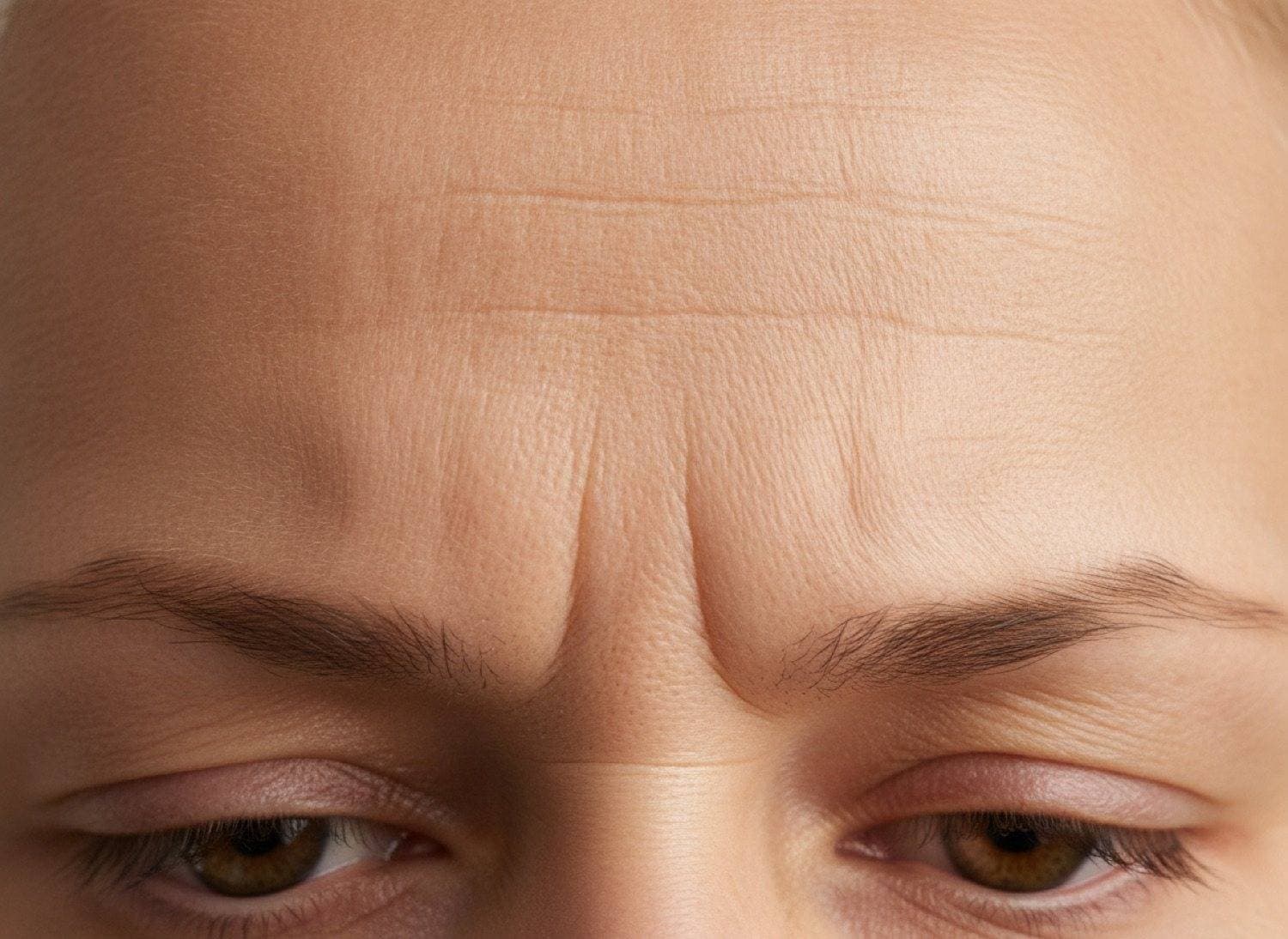 Before Softened forehead and frown lines, still natural at The Body Bar MD